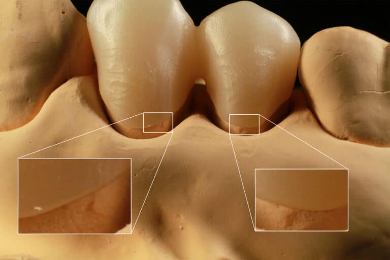 ラボ用CAD/CAMセレックinLabを用いたデジタル歯科技工の精度